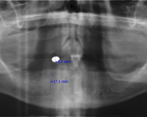 Zeramex loc Locator, Zeramex P Implantat