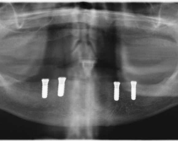 Zeramex loc Locator, Zeramex P Implantat