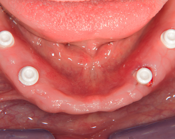 Zeramex loc Locator, Zeramex P Implantat, Novaloc, Valoc, PEEK Gerüst